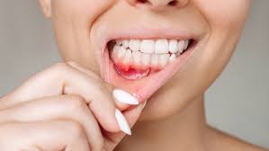 Gum Disease